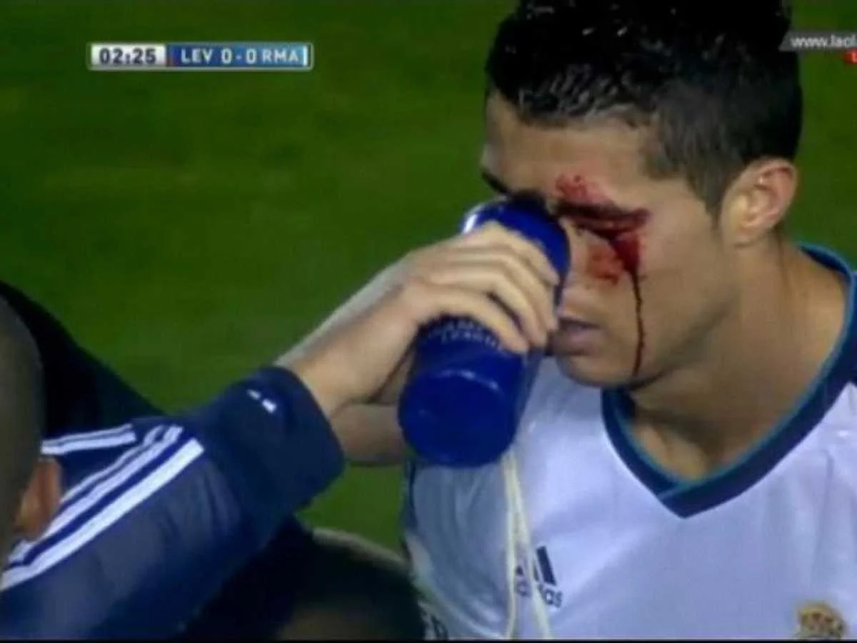 Так выглядел Роналду после столкновения с Наварро