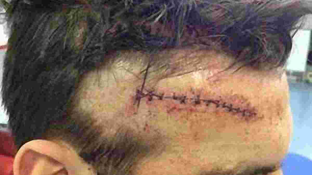 Тринадцять швів на голові після укусу "вовка" з Бразилії