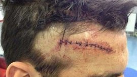 Тринадцать швов на голове после укуса "волка" из Бразилии Тринадцать швов на голове после укуса "волка" из Бразилии